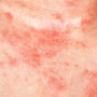 What is Eczema and How to Treat It using HVSC - Hudson Valley Skin Care