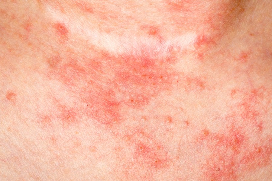 What is Eczema and How to Treat It using HVSC